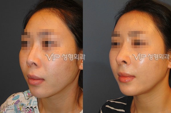 	Rib cartilage Rhinoplasty, Contracted Nose, Revision Rhinoplasty	 - Rib cartilage rhinoplasty