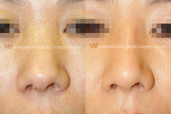 	Nose Surgery, Revision Rhinoplasty	 - Silicone showing nose correction