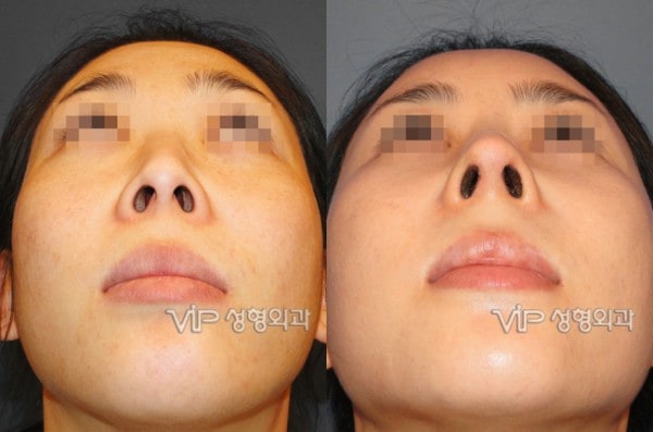 	Rib cartilage Rhinoplasty, Contracted Nose, Revision Rhinoplasty	 - Rib cartilage rhinoplasty