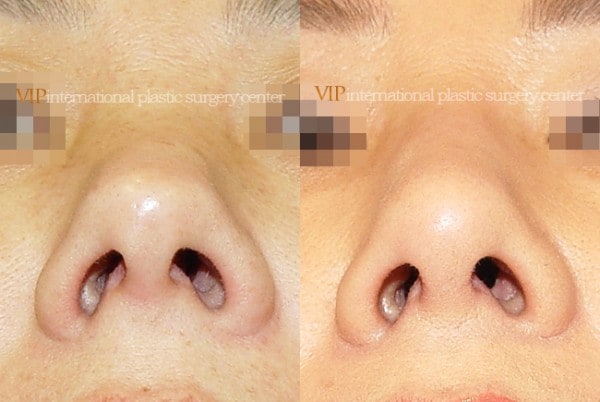 	Nose Surgery, Revision Rhinoplasty	 - Silicone showing nose correction