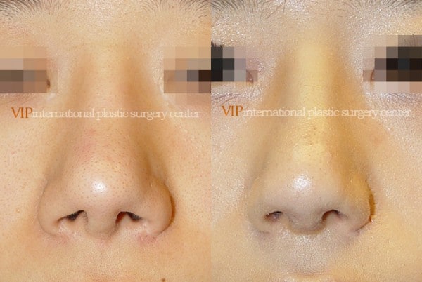 Nose Surgery - Nostril correction