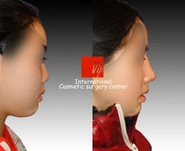 Short & Flat nose - Rib cartilage rhinoplasty