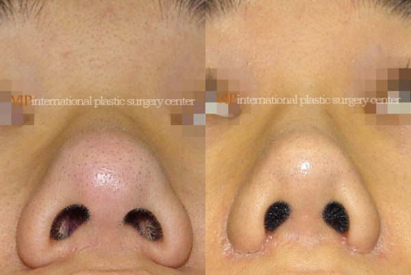 Nose Surgery - Alar base reduction