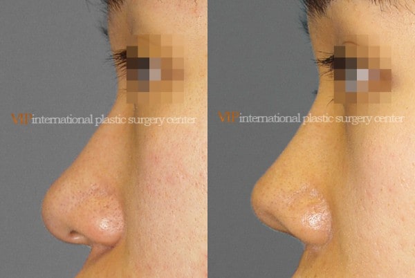 Nose Surgery - Alar base reduction