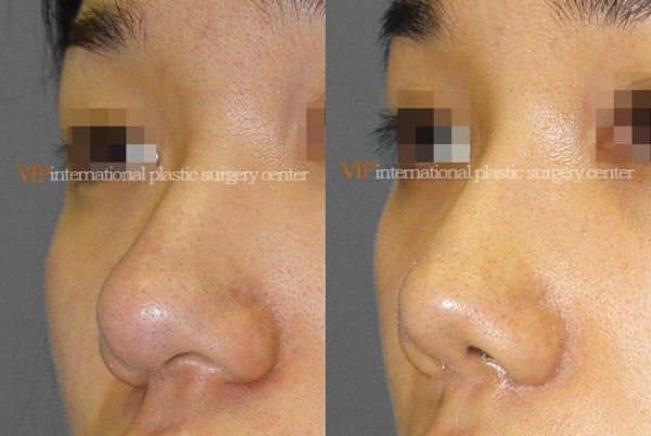 Nose Surgery - Alar base reduction