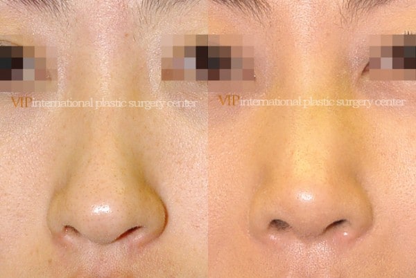 Nose Surgery - Septal cartilage rhinoplasty