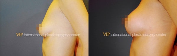 Breast Surgery - Breast surgery