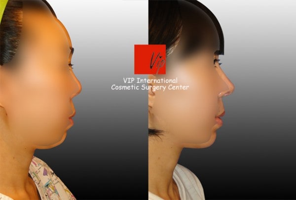 	Rib cartilage Rhinoplasty, Contracted Nose, Revision Rhinoplasty	 - Harmony rhinoplasty - Septal deviation correction+balanced profile view