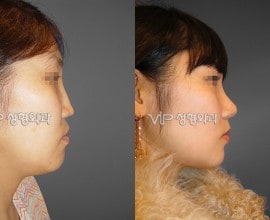 VIP Harmony rhinoplasty