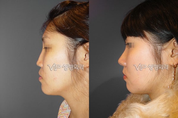 	Harmony-Rhinoplasty, Protruded Mouth Correction Rhinoplasty, Rib cartilage Rhinoplasty	 - VIP Harmony rhinoplasty