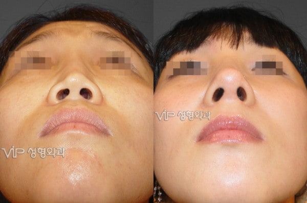 	Harmony-Rhinoplasty, Protruded Mouth Correction Rhinoplasty, Rib cartilage Rhinoplasty	 - VIP Harmony rhinoplasty