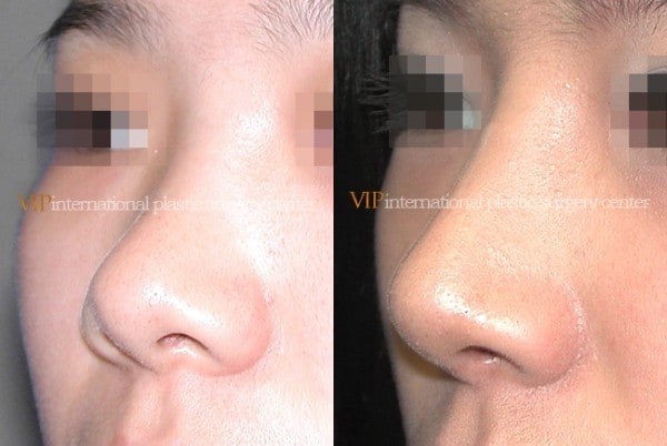 	Nose Surgery	 - Bulbous nose