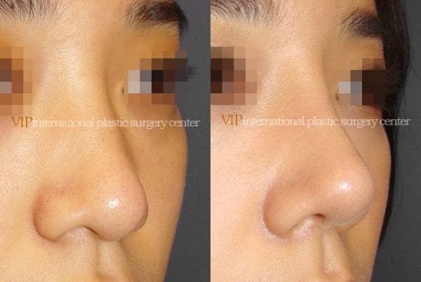 	Nose Surgery	 - Wide nasal bone reduction rhinoplasty