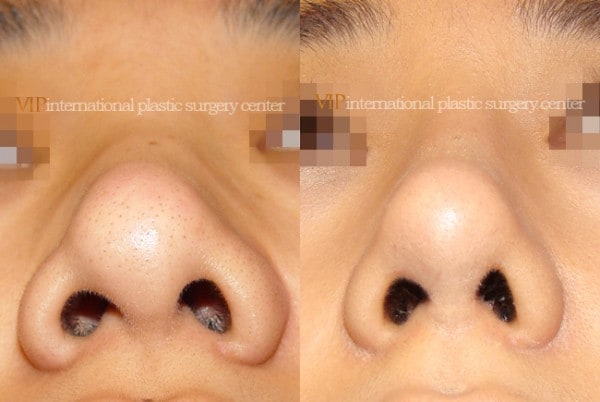 	Nose Surgery	 - Wide nasal bone reduction rhinoplasty