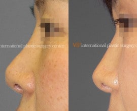 Revision rhinoplasty - Tip correction