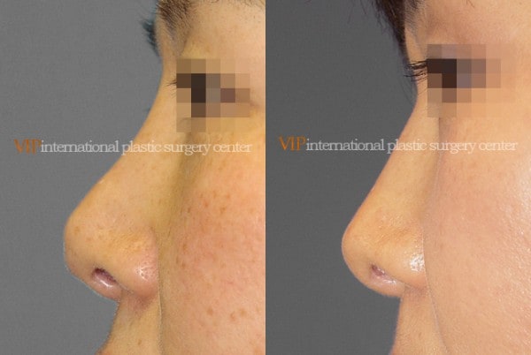 Nose Surgery - Revision rhinoplasty - Tip correction