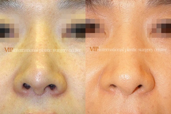 Nose Surgery - Revision rhinoplasty - Tip correction