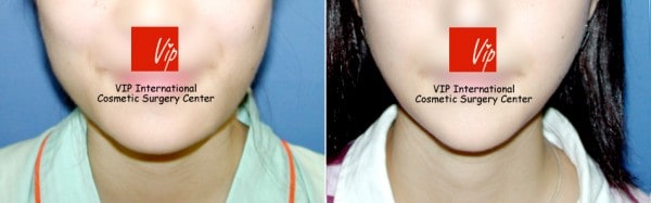 Facial Bone Surgery - V-line jaw reduction ( T-Square surgery )