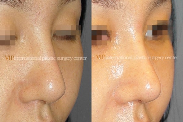 	Nose Surgery	 - Wide nasal bone reduction rhinoplasty