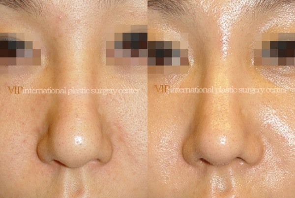 	Nose Surgery	 - Wide nasal bone reduction rhinoplasty