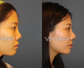 Revision rhinoplasty with Septal cartilage