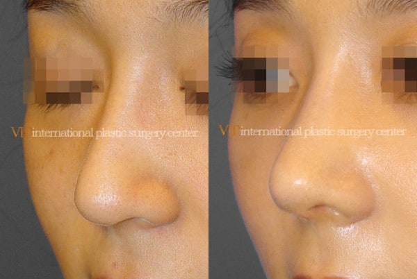 Nose Surgery - Septal cartilage rhinoplasty