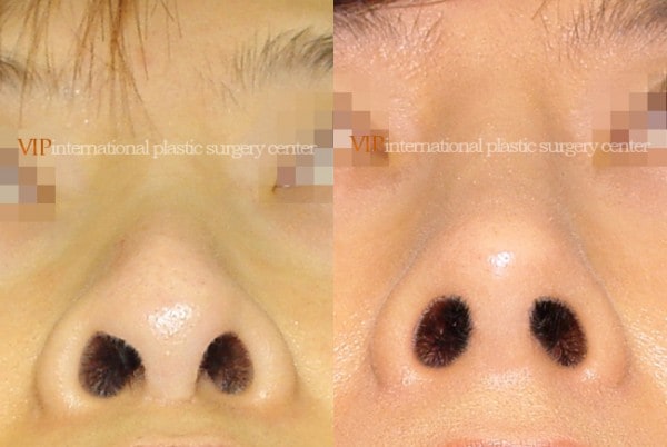 Nose Surgery - Nostril correction