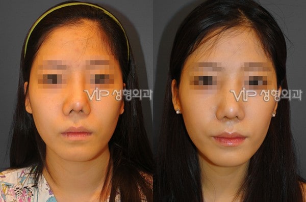 Nose Surgery - Revision rhinoplasty with Septal cartilage