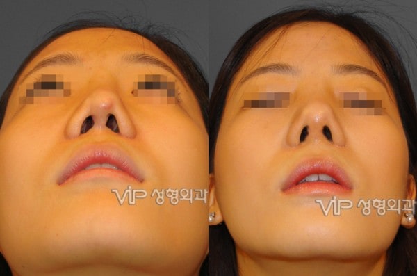 Nose Surgery - Revision rhinoplasty with Septal cartilage