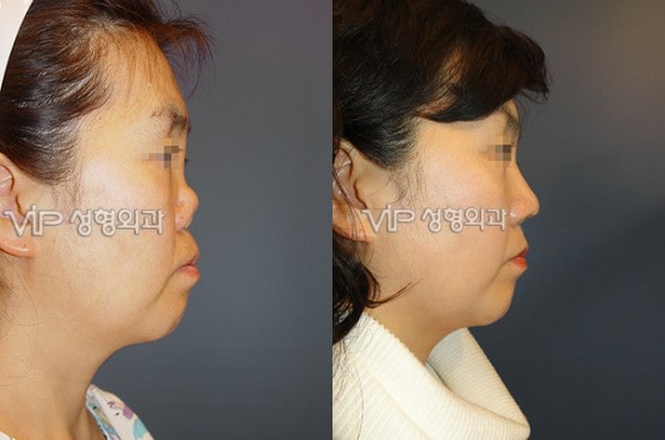 Nose Surgery - Revision rhinoplasty with Rib cartilage - Severe collapsion and contruction due to silicone implant