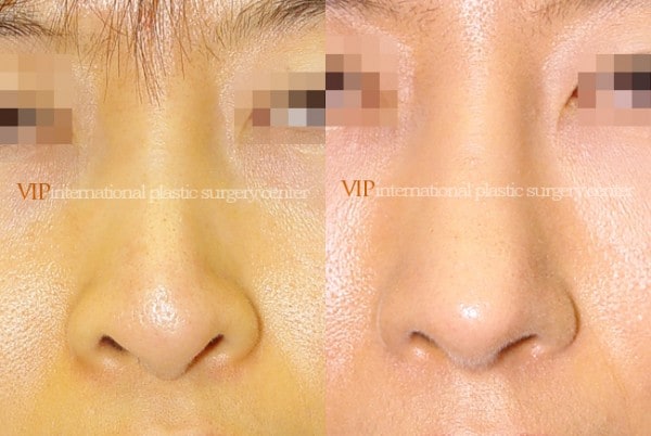 Nose Surgery - Nostril correction