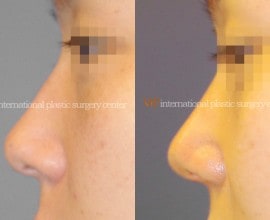 Rhinoplasty