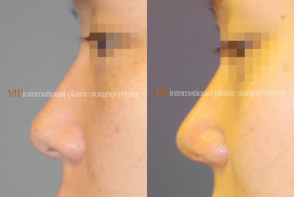 Nose Surgery - Rhinoplasty