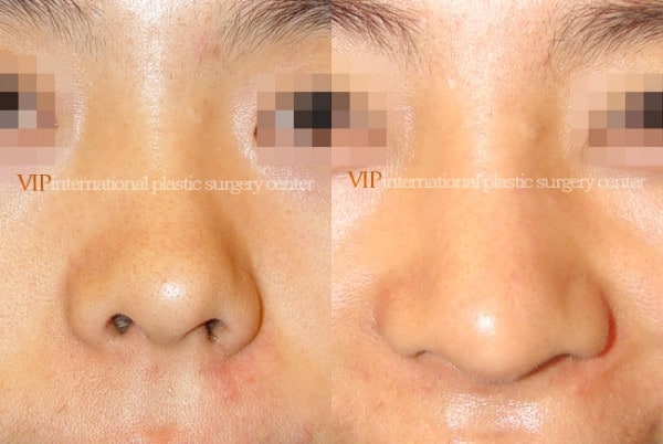 Nose Surgery - Septal deviation correction