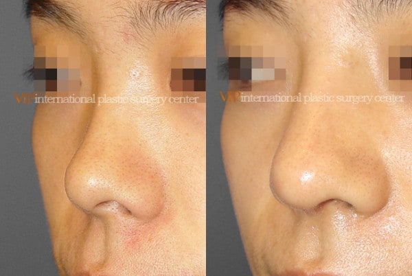 Nose Surgery - Septal deviation correction