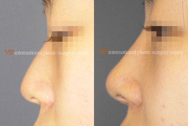 Nose Surgery - Rib cartilage rhinoplasty