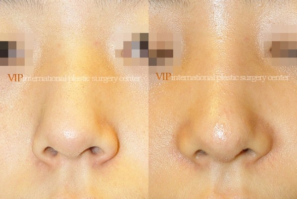 Nose Surgery - Rib cartilage rhinoplasty