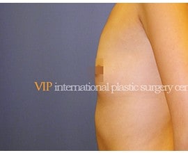 Breast surgery