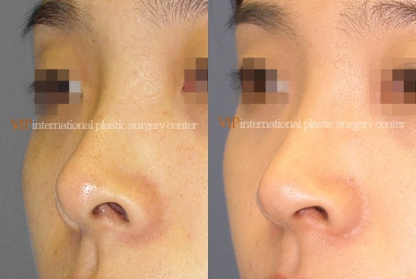 Nose Surgery - Nostril correction