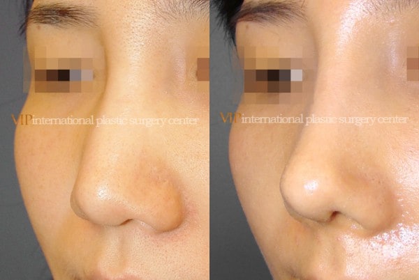 	Nose Surgery	 - Wide nasal bone reduction rhinoplasty