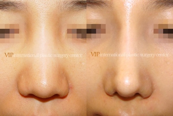 	Nose Surgery	 - Wide nasal bone reduction rhinoplasty