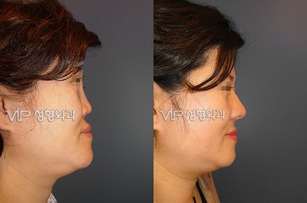 	Harmony-Rhinoplasty, Protruded Mouth Correction Rhinoplasty, Rib cartilage Rhinoplasty	 - Revision- correction of depressed nose with Rib cartilage