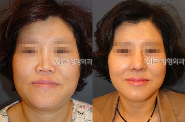 	Harmony-Rhinoplasty, Protruded Mouth Correction Rhinoplasty, Rib cartilage Rhinoplasty	 - Revision- correction of depressed nose with Rib cartilage