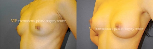 Breast Surgery - Breast surgery