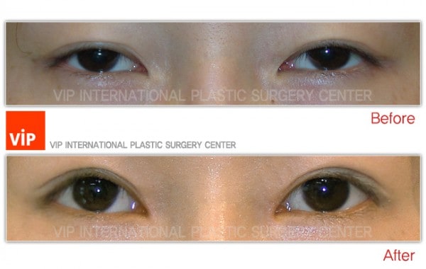 	Eye Surgery, Double Fold, Ptosis Correction	 - Ptosis correction