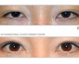 Ptosis correction