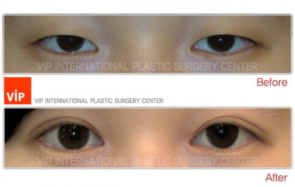 	Eye Surgery, Double Fold, Ptosis Correction	 - Ptosis correction