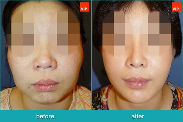 	Nose Surgery, Rib cartilage Rhinoplasty, Facial Bone Surgery, Stem Cell Fat Graft	 - Rib Cartilage Rhinoplasty, Face Contouring Surgery, V-line Surgery, Fat Graft, Cheekbone Reduction