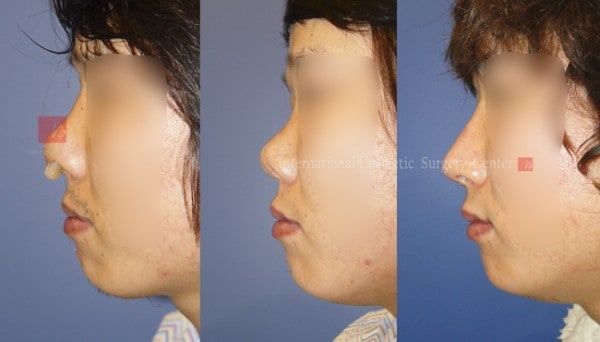 	Protruded Mouth Correction Rhinoplasty, Contracted Nose, Revision Rhinoplasty	 - Silicone showing/infection