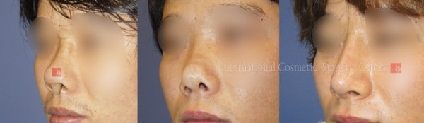 	Protruded Mouth Correction Rhinoplasty, Contracted Nose, Revision Rhinoplasty	 - Silicone showing/infection